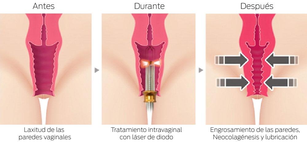 Tratamientos de Láser Váginal